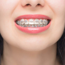 Mujer con ortodoncia autoligable