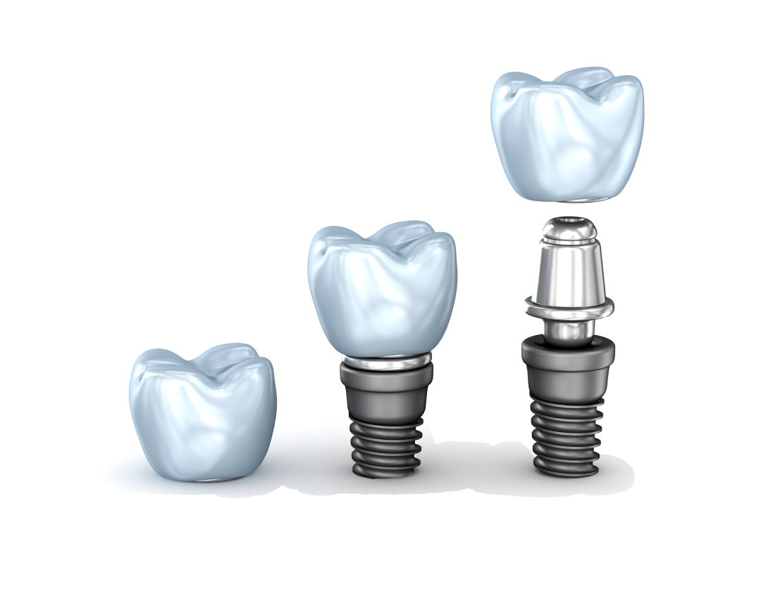 Imagen de implantes dentales generados en 3d